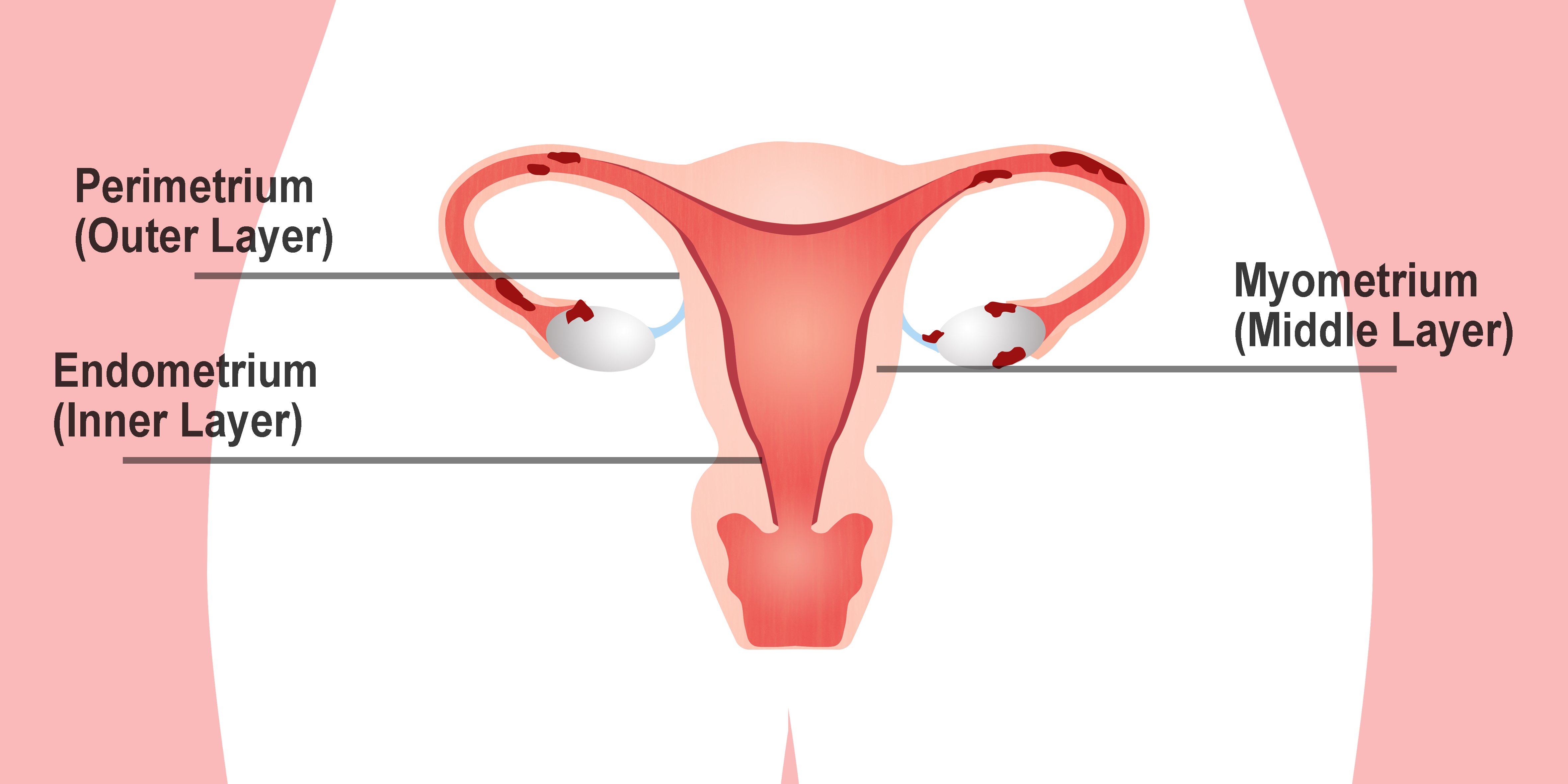 Endometriosis Stages Chart